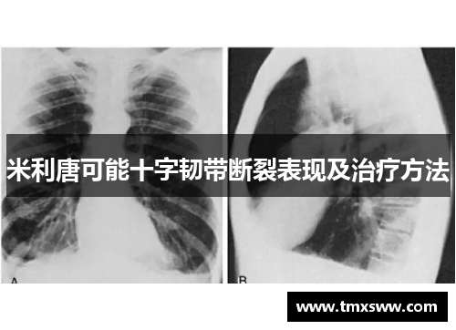 米利唐可能十字韧带断裂表现及治疗方法